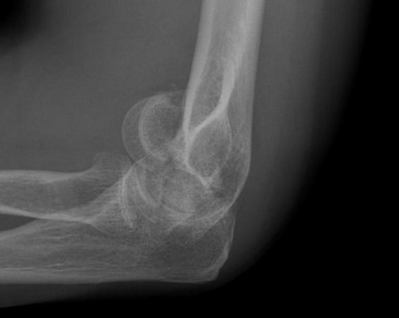 Elbow Capitellar Fracture